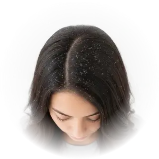 Dandruff